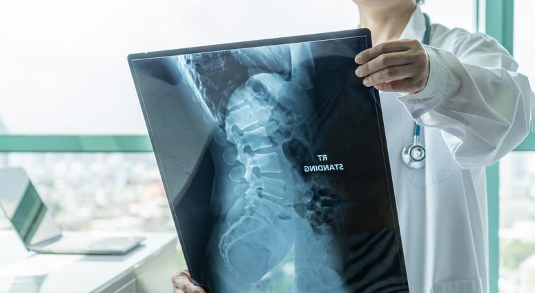 Spinal Muscular Atrophy Spinal Muscular Atrophy