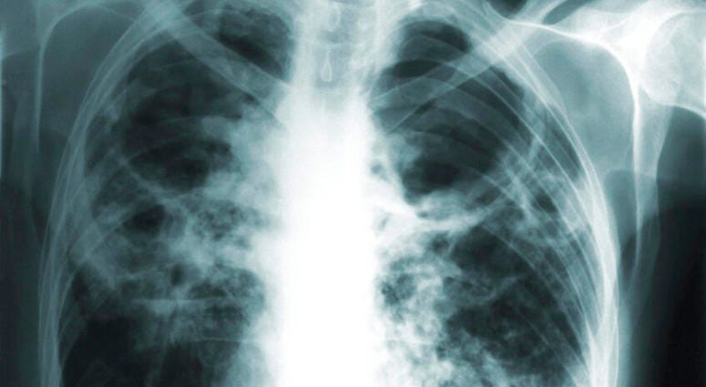 This 1966 image made available by the Centers of Disease Control and Prevention shows a chest x-ray of a tuberculosis patient. This 1966 image made available by the Centers of Disease Control and Prevention shows a chest x-ray of a tuberculosis patient.
