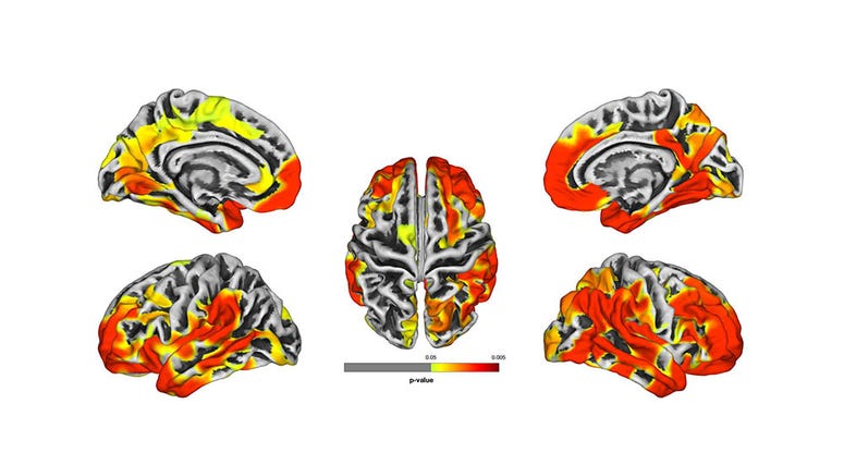 These brain images are a compilation of MRI results from WTC responders. The images show gray matter atrophy on the brain, with yellow and red areas revealing statistically significant atrophy compared to the normal population. Red areas show worse. 9/11 MRIS