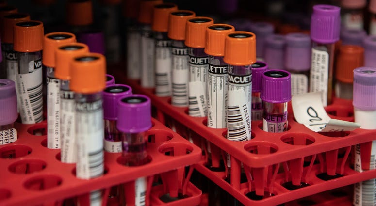 MILAN, ITALY - MARCH 05: Vials are displayed on a tray during a Coronavirus swab test process in the Molecular biology laboratory of the Ospedale Niguarda, on March 05, 2020 in Milan