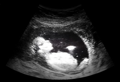 ultrasound