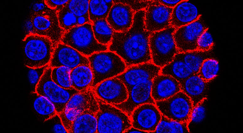 pancreatic cancer cells, nuclei in blue