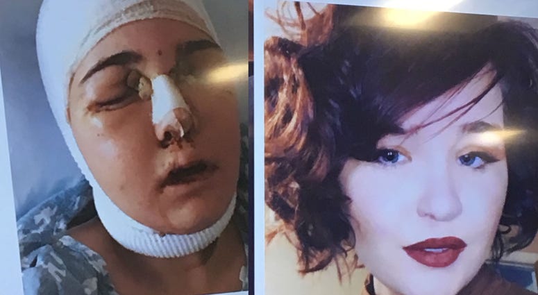 Nicole Sincavage before and after surgery Nicole Sincavage before and after surgery
