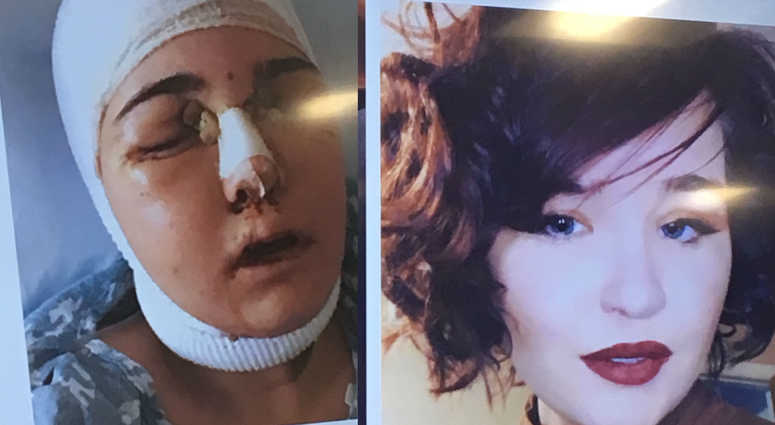 Nicole Sincavage before and after surgery Nicole Sincavage before and after surgery