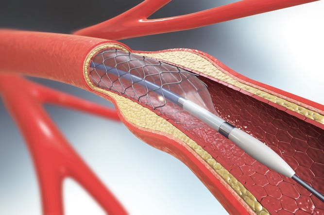 stent stent