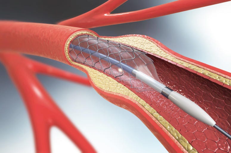 stent stent