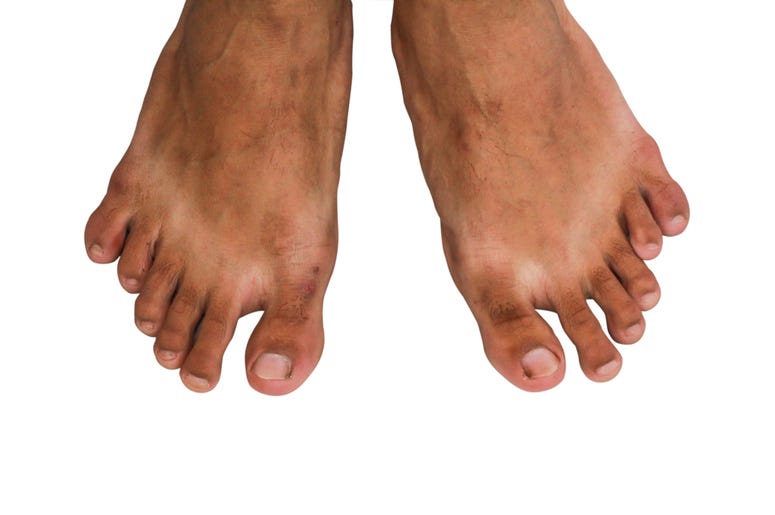 Six Toes
