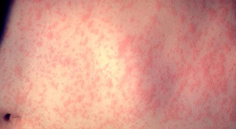 measles measles