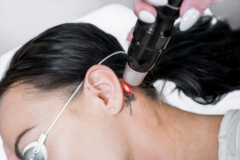 Weird Pandemic Side Effect: Everyone Wants Their Tattoos Removed